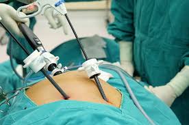 laparoskopik-kolesistektomi